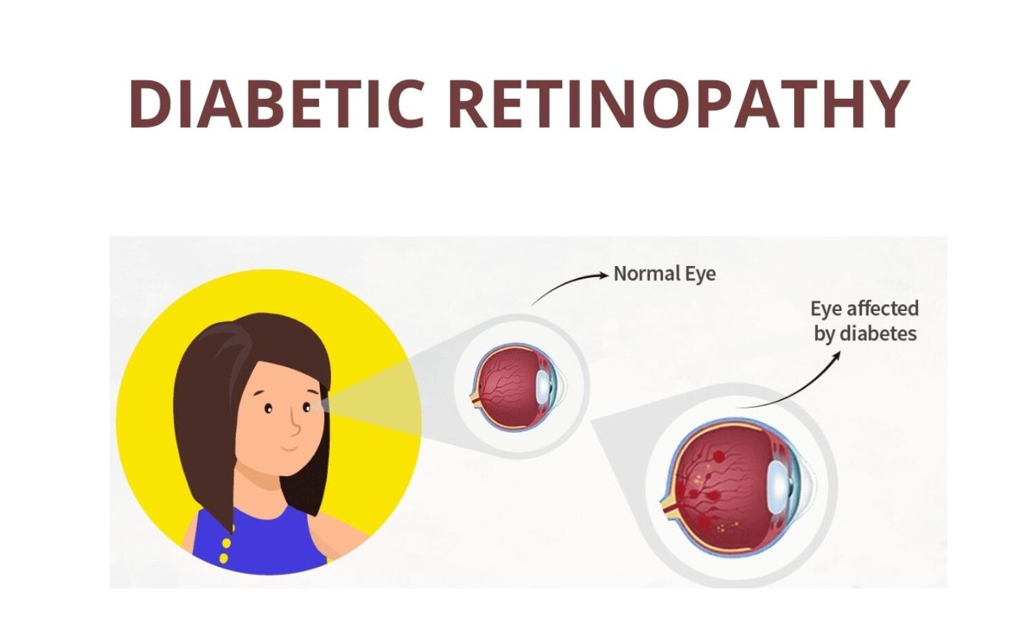 Diabetic Retinopathy Treatment in Ayurveda
