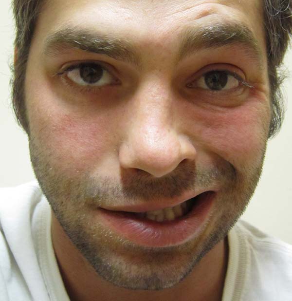 Facial Contractions