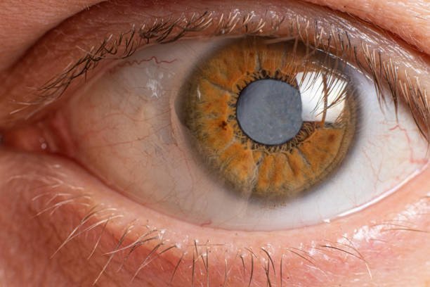 Glaucoma and ayurvedic treatment