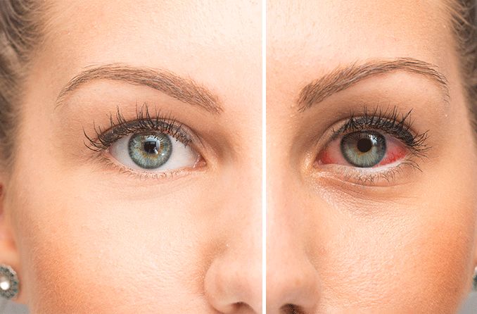 Causes of Dry Eyes