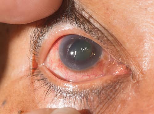 Redness in Eyes